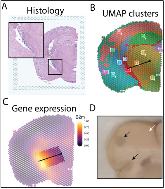 Spatial Transcriptomics of Meningeal Inflammation Reveals Variable Penetrance of Inflammatory Gene Signatures into Adjacent Brain Parenchyma